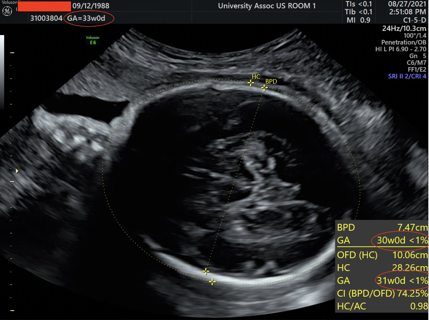 A third-trimester ultrasound scan